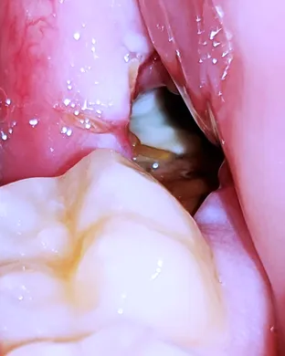 Dry Socket